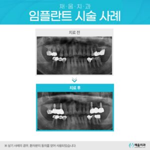 사상임플란트치과