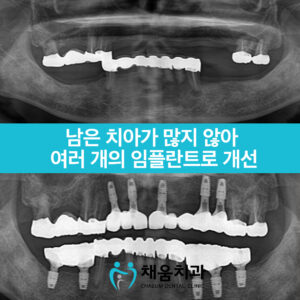괘법동임플란트