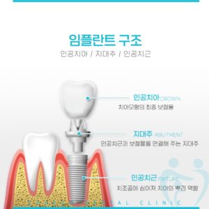 임플란트구조