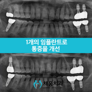 채움치과 증례썸네일