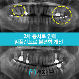 채움치과 증례썸네일