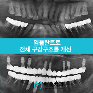 채움치과 증례썸네일