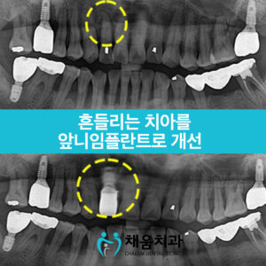 채움치과 증례썸네일